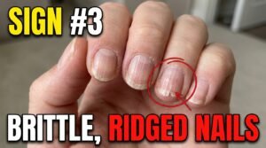 brittle nails 